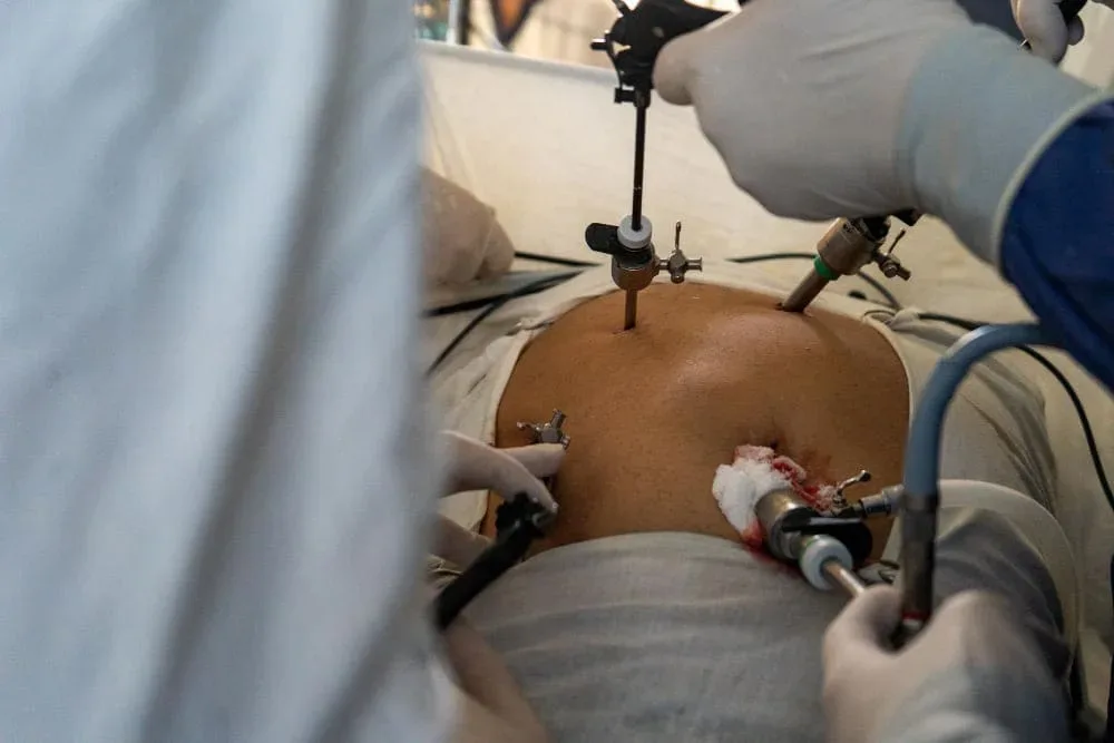Cirugía de hernia hiatal en Jalisco y Colima