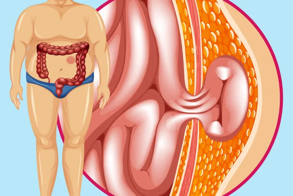 Experto en hernias de pared abdominal (ventrales, inguinales, umbilicales)